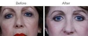 Brow Lift Before & After