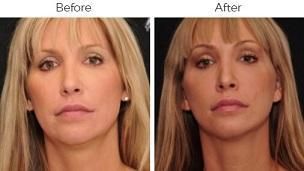 Brow Lift Before & After