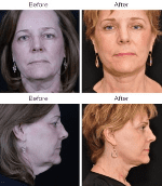 Brow Lift Before & After