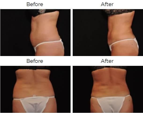 Liposuction Before & After