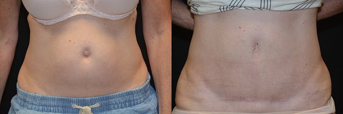 Liposuction Before & After