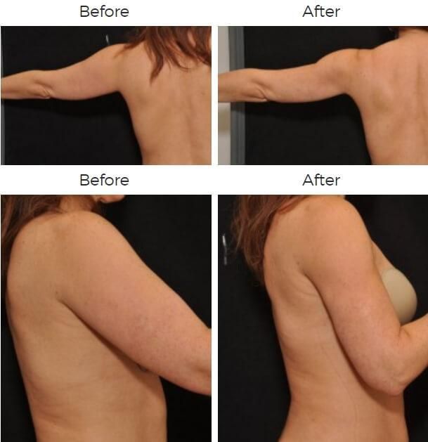 Liposuction Before & After