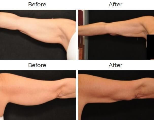 Liposuction Before & After