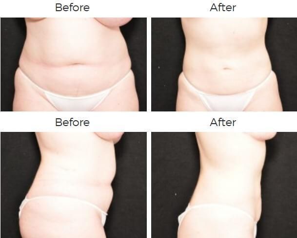 Liposuction Before & After