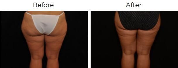 Liposuction Before & After