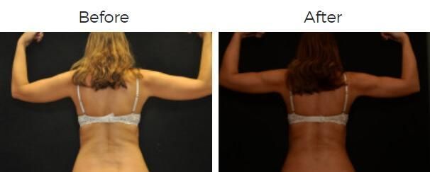 Liposuction Before & After