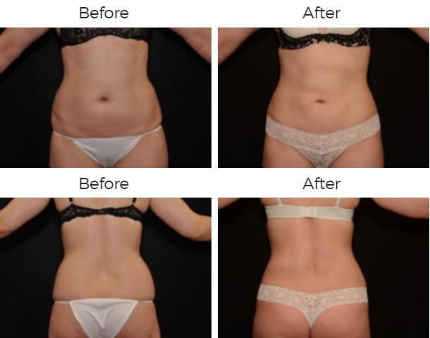 Liposuction Before & After