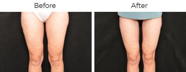 Liposuction Before & After