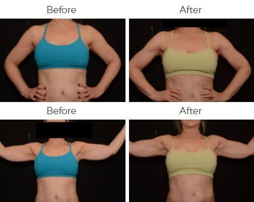 Liposuction Before & After