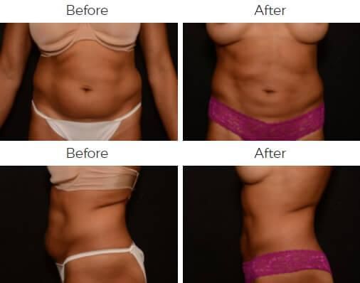 Liposuction Before & After
