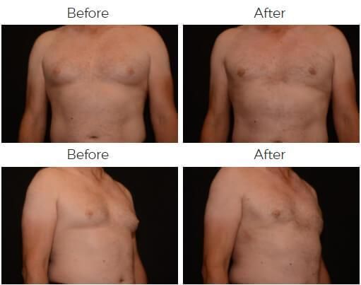 Liposuction Before & After