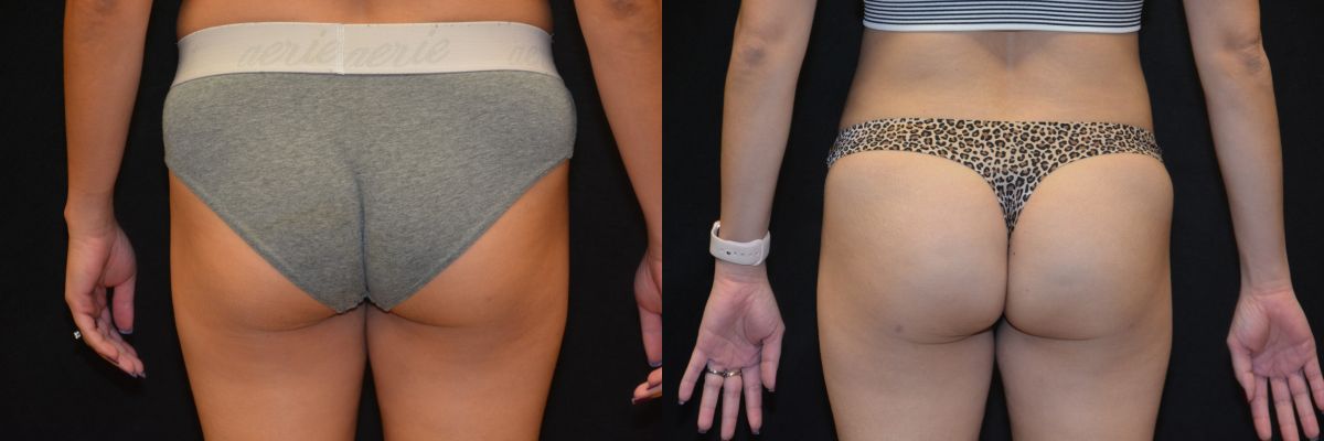 Liposuction Before & After