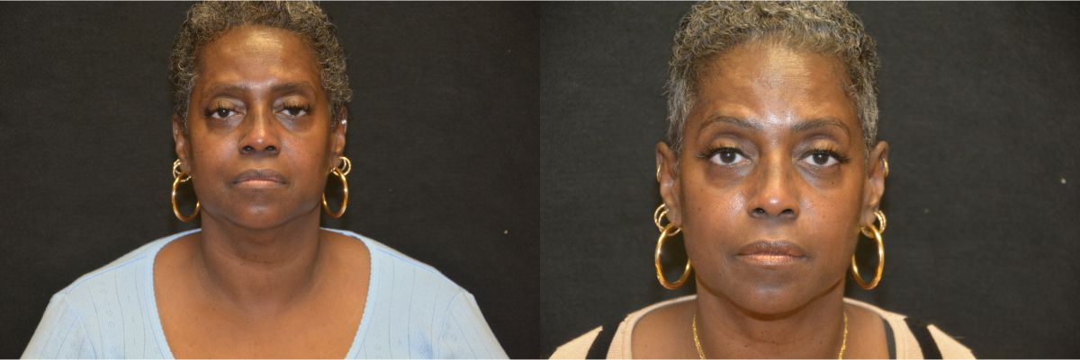 Liposuction Before & After