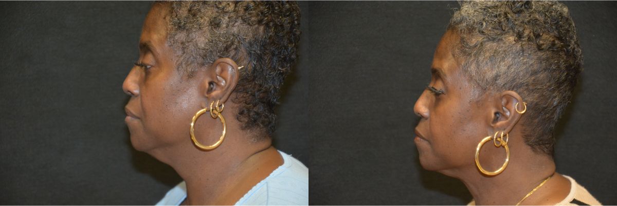 Liposuction Before & After