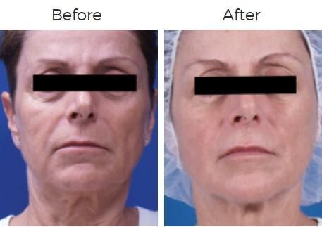 Venus Legacy Before & After