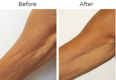 Venus Legacy Before & After