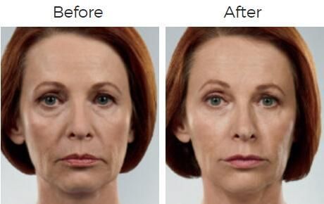 Juvederm Before & After
