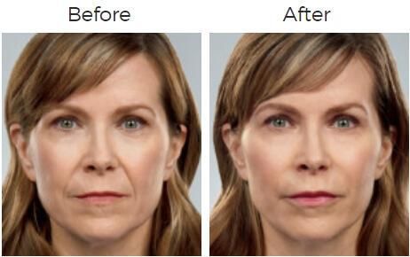 Juvederm Before & After