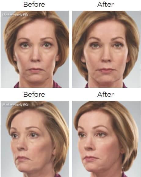 Juvederm Before & After