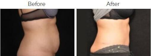 Tummy Tuck Before & After