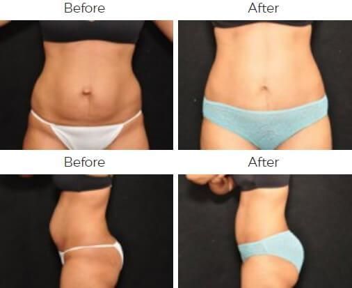 Tummy Tuck Before & After