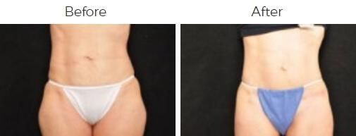Tummy Tuck Before & After