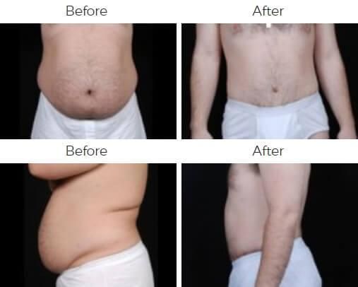 Tummy Tuck Before & After