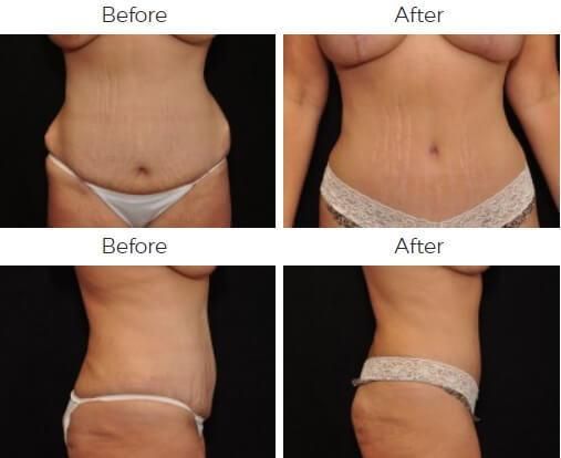 Tummy Tuck Before & After