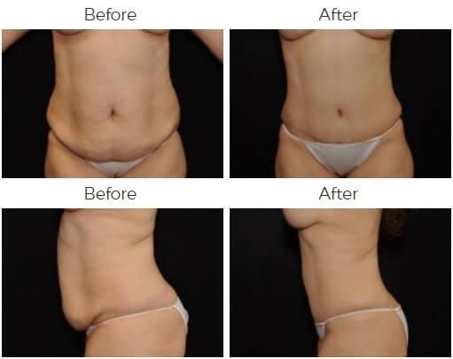 Tummy Tuck Before & After