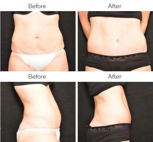 Tummy Tuck Before & After
