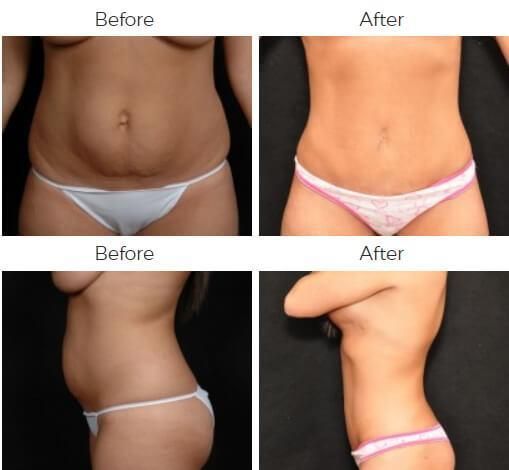 Tummy Tuck Before & After