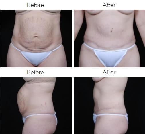 Tummy Tuck Before & After
