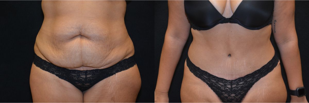 Tummy Tuck Before & After