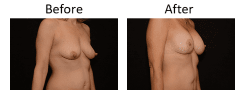 Breast Lift Before & After