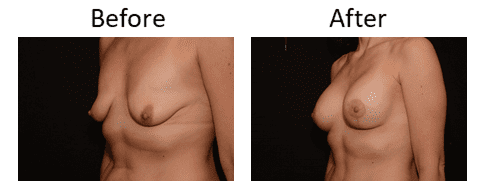 Breast Lift Before & After