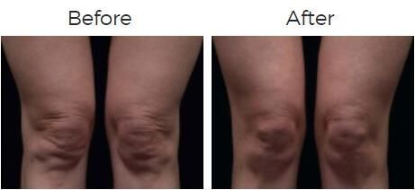 Thermage Before & After