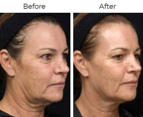 Thermage Before & After