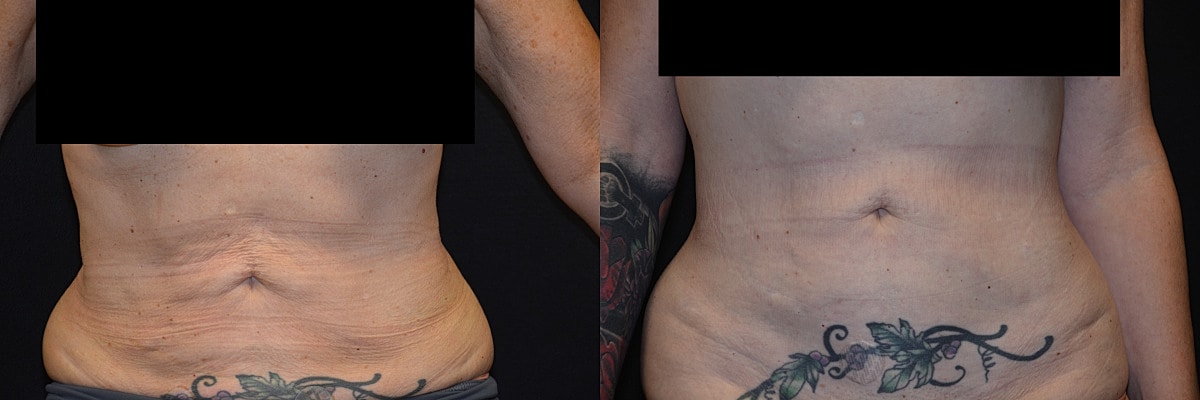 Reverse Abdominoplasty Before & After