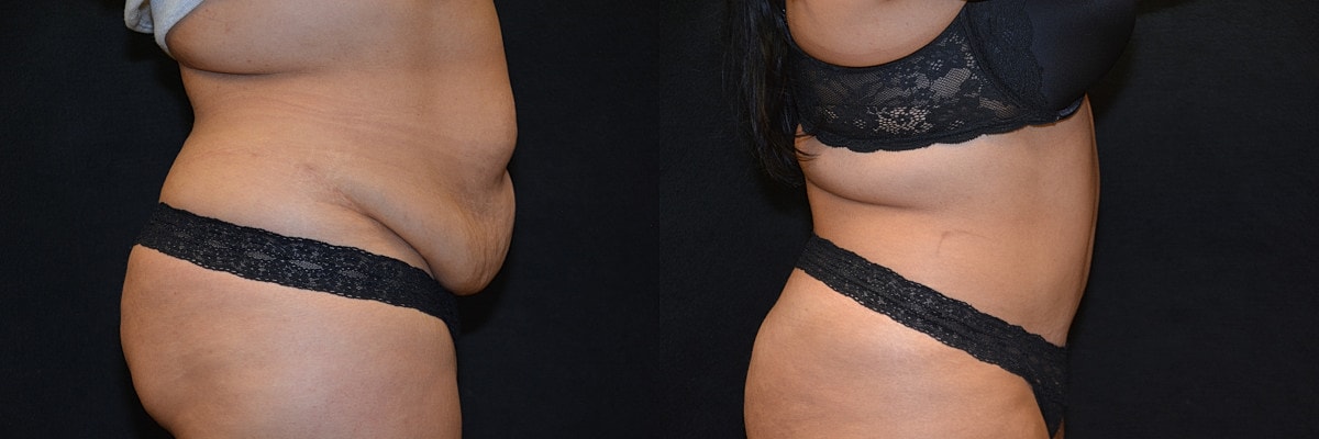 Abdominoplasty Before & After