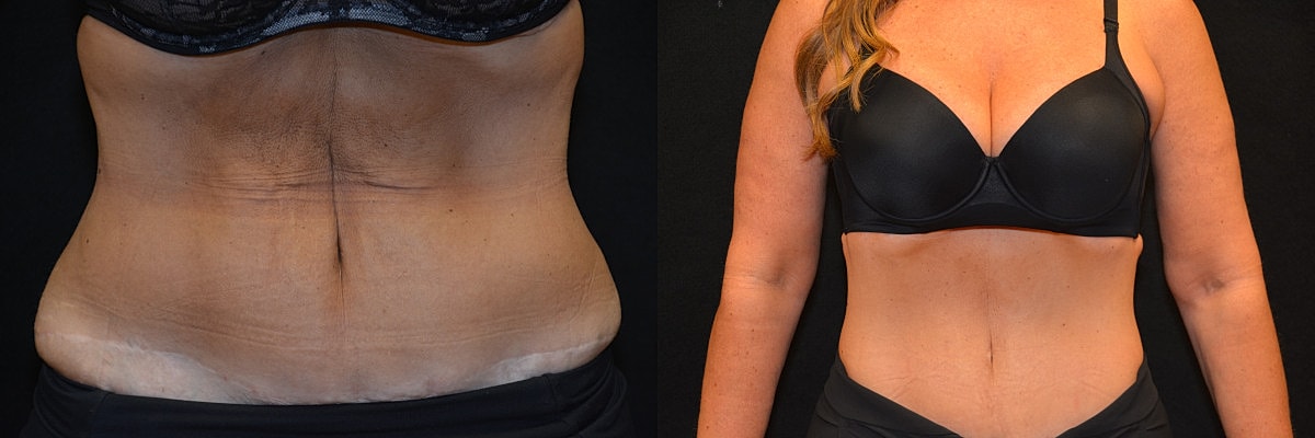 Abdominoplasty Before & After