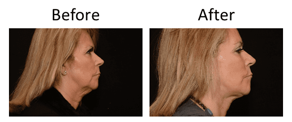 Facelift Before & After