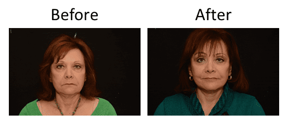 Facelift Before & After