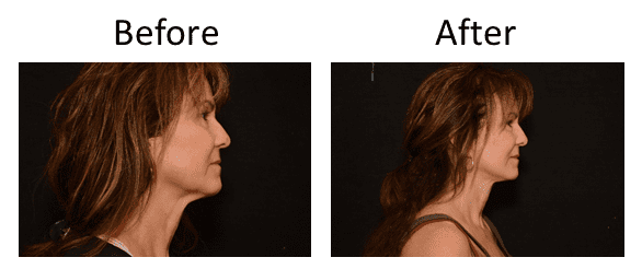 Facelift Before & After