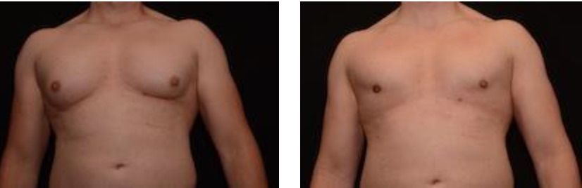 Gynecomastia Before & After