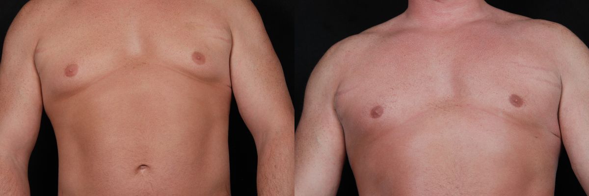 Gynecomastia Before & After