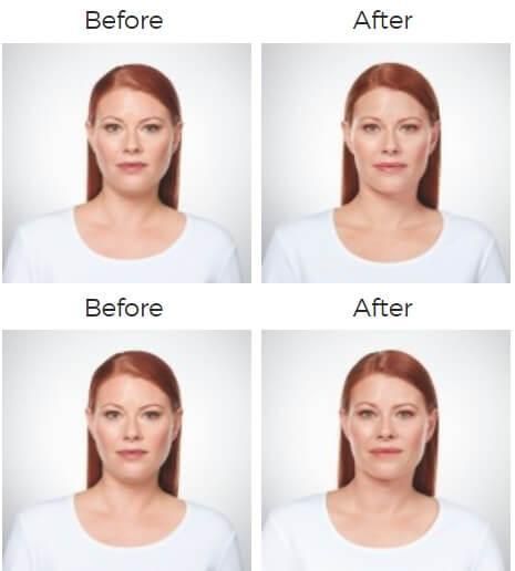 Kybella Before & After