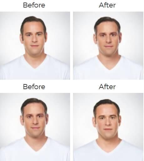 Kybella Before & After