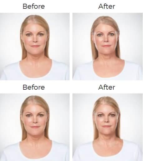Kybella Before & After