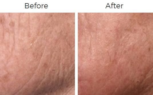 Fraxel Before & After