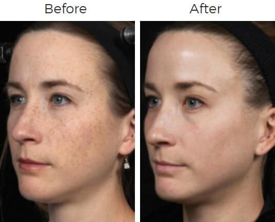 Fraxel Before & After